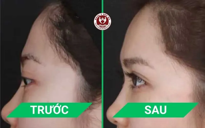HÌnh ảnh trước và sau điều trị mắt lồi bệnh cường giáp bởi bác sĩ Phạm Thị Thu Hà